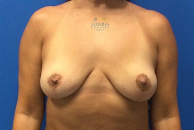 Breast Implant Removal Before & After Gallery - Patient 154948908 - Image 2