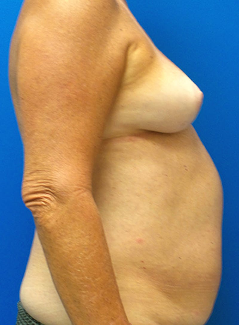 Nipple Sparing Breast Reconstruction Before & After Gallery - Patient 154948897 - Image 7