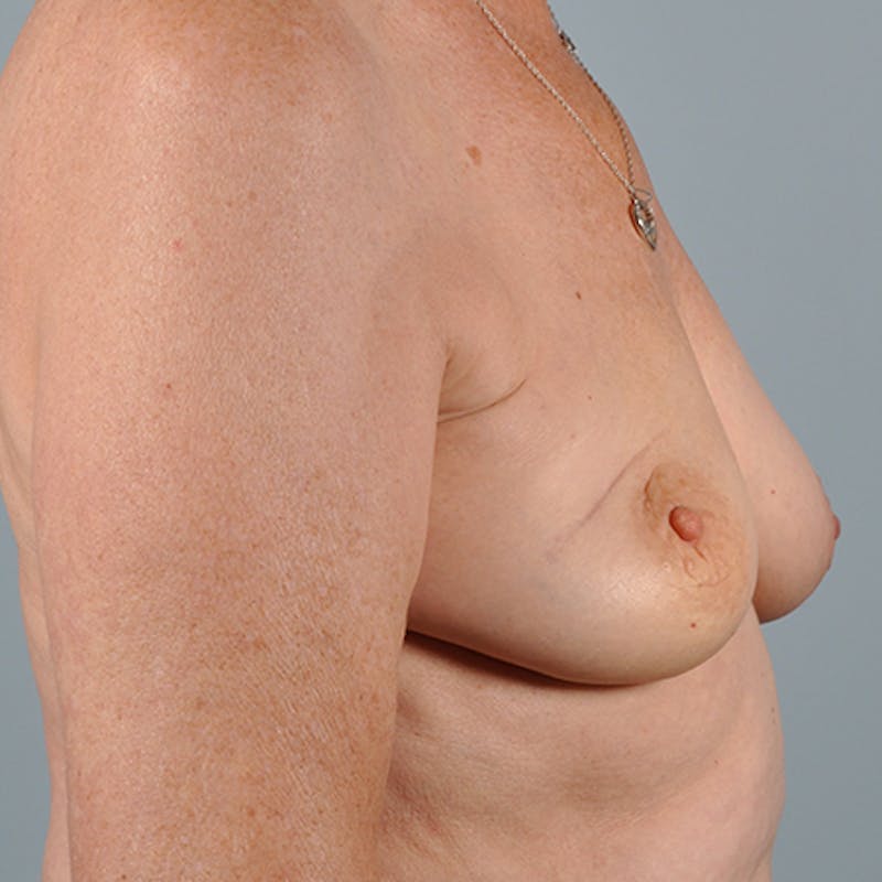 Latissimus Flap Reconstruction Before & After Gallery - Patient 154948900 - Image 5