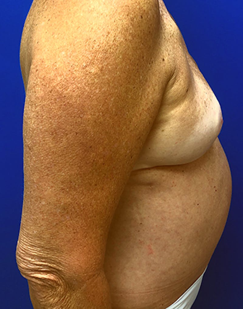 Nipple Sparing Breast Reconstruction Before & After Gallery - Patient 154948897 - Image 8