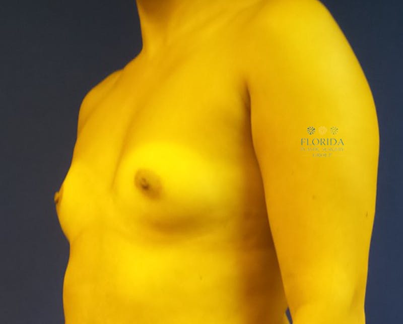 Saline Breast Augmentation Before & After Gallery - Patient 154948909 - Image 3
