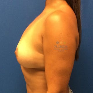 Breast Implant Removal Before & After Gallery - Patient 154948908 - Image 4
