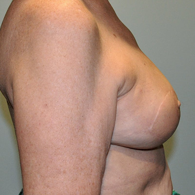 Latissimus Flap Reconstruction Before & After Gallery - Patient 154948900 - Image 6