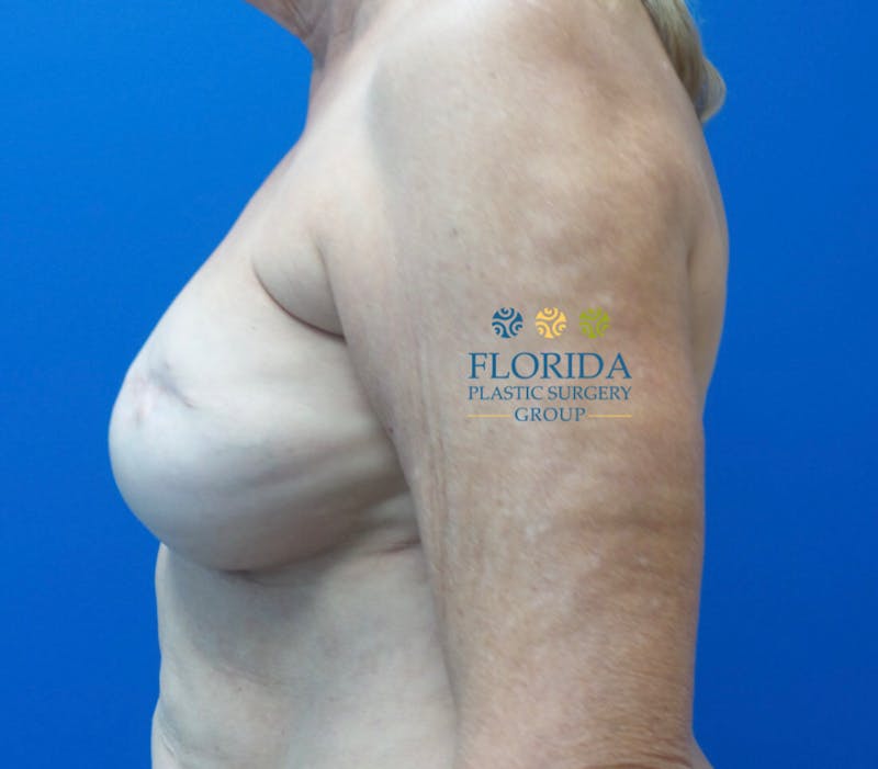 Breast Reconstruction Revision Before & After Gallery - Patient 154948907 - Image 3
