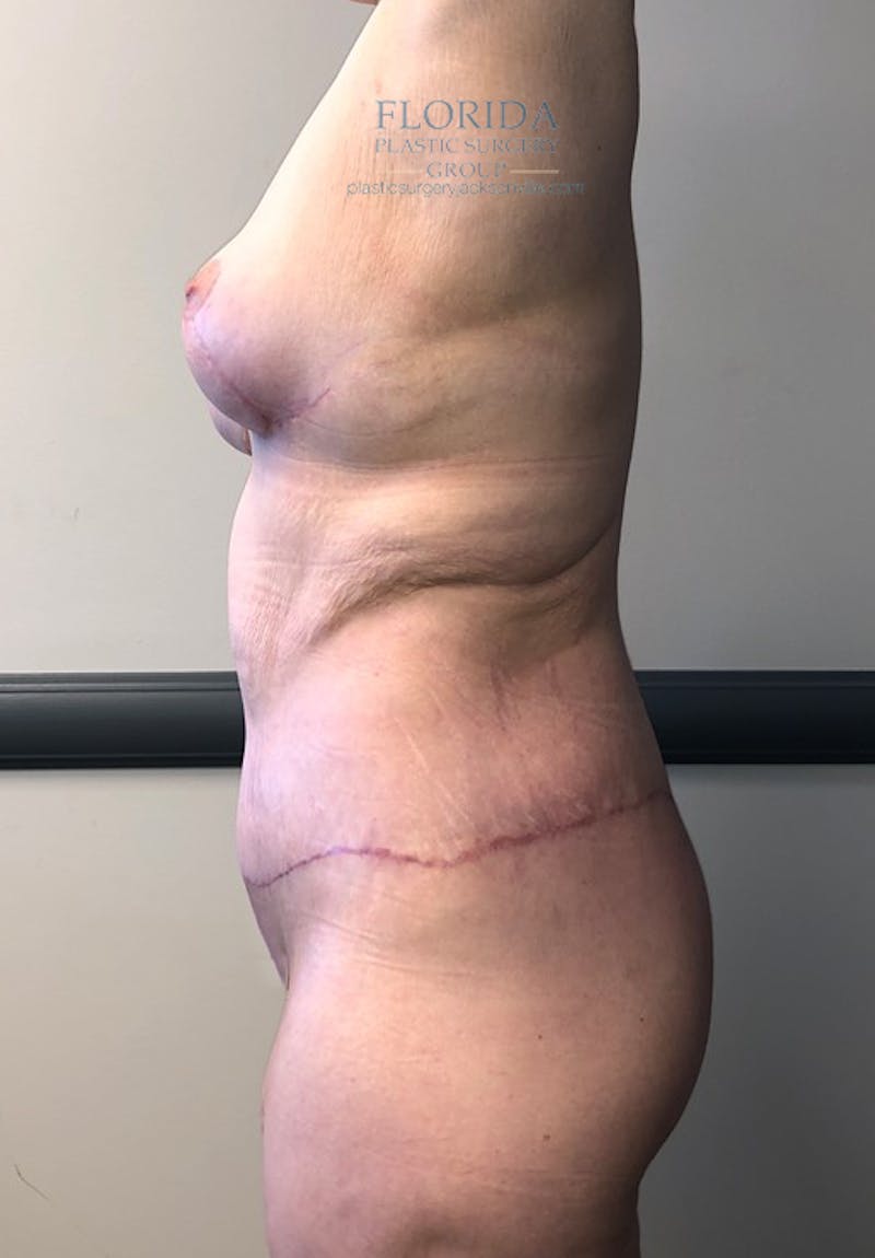 Lower Body Lift Before & After Gallery - Patient 154948902 - Image 2