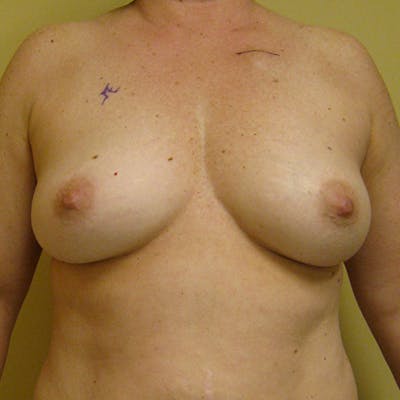 DIEP Flap Reconstruction Before & After Gallery - Patient 154948915 - Image 1