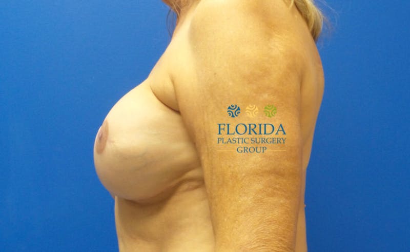 Breast Reconstruction Revision Before & After Gallery - Patient 154948907 - Image 4