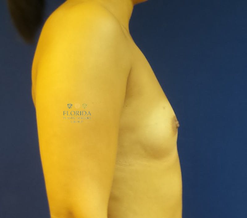 Saline Breast Augmentation Before & After Gallery - Patient 154948909 - Image 5