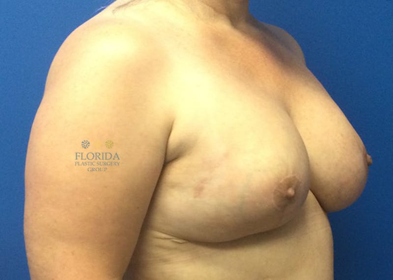 Post Lumpectomy Reconstruction Before & After Gallery - Patient 154948912 - Image 4