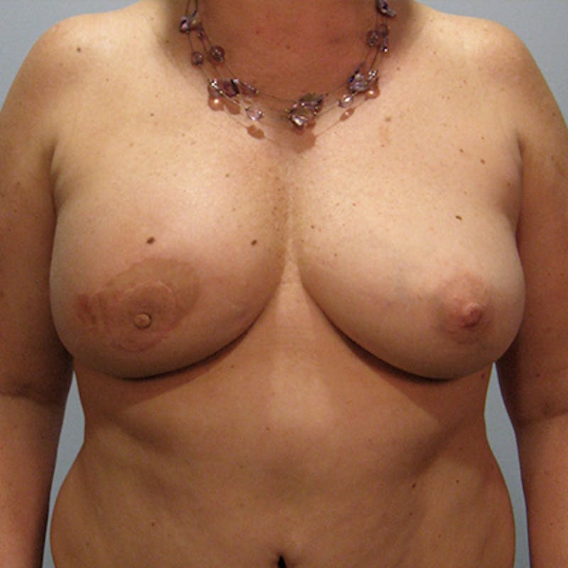DIEP Flap Reconstruction Before & After Gallery - Patient 154948915 - Image 2