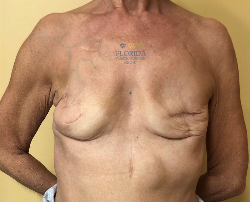Breast Reconstruction Revision Before & After Gallery - Patient 154948934 - Image 1