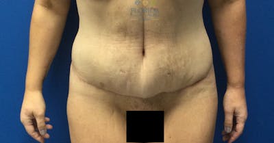 Lower Body Lift Before & After Gallery - Patient 154948913 - Image 2