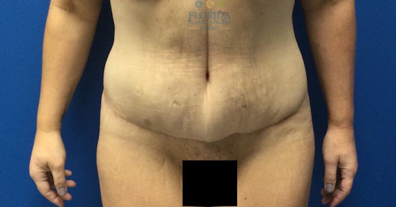 Lower Body Lift Before & After Gallery - Patient 154948913 - Image 2