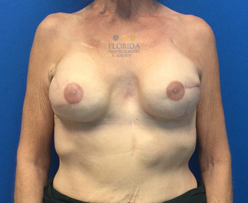 Breast Reconstruction Revision Before & After Gallery - Patient 154948934 - Image 2
