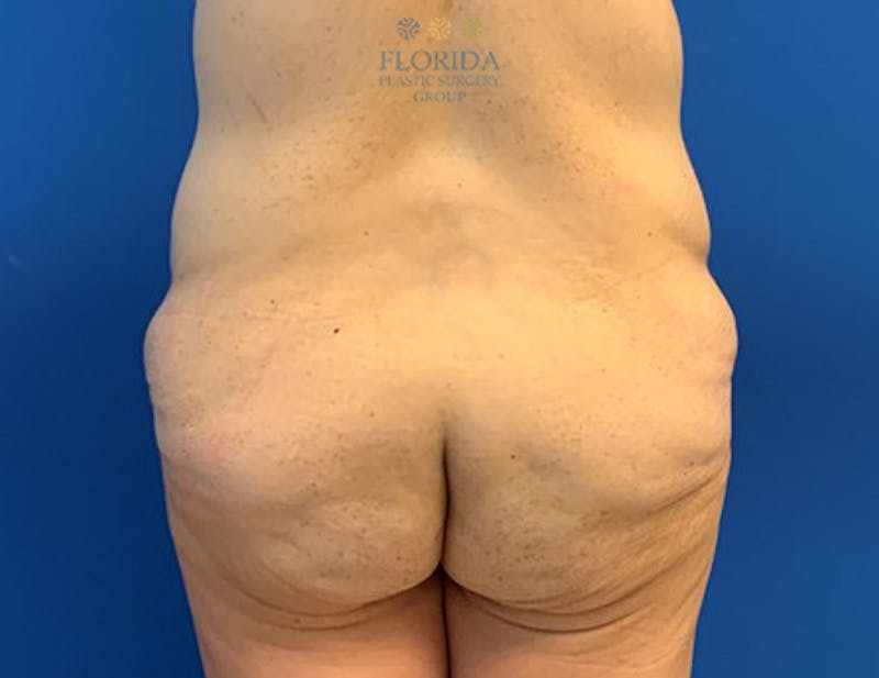 Lower Body Lift Before & After Gallery - Patient 154948913 - Image 3