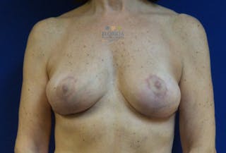Breast Implant Removal Before & After Gallery - Patient 154948920 - Image 2