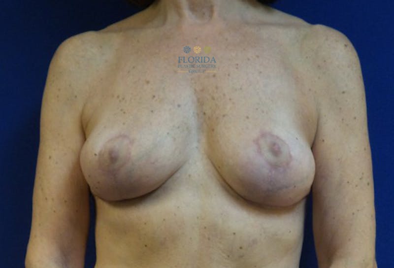 Breast Implant Removal Before & After Gallery - Patient 154948920 - Image 2