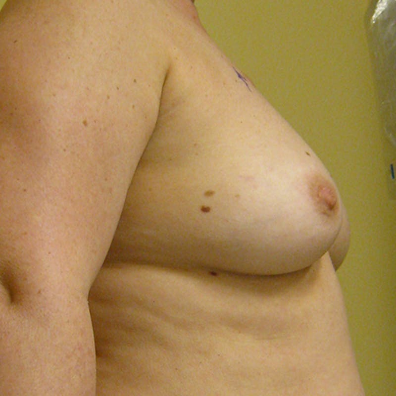DIEP Flap Reconstruction Before & After Gallery - Patient 154948915 - Image 5