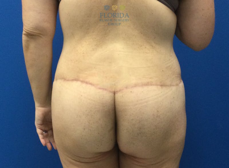 Lower Body Lift Before & After Gallery - Patient 154948913 - Image 4