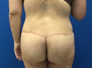 Lower Body Lift Before & After Gallery - Patient 154948913 - Image 4