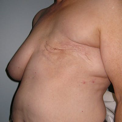 Latissimus Flap Reconstruction Before & After Gallery - Patient 154948919 - Image 1