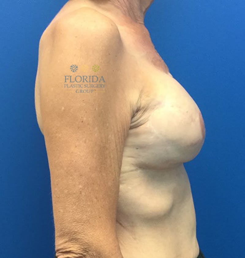 Breast Reconstruction Revision Before & After Gallery - Patient 154948934 - Image 4