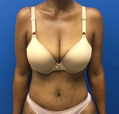Abdominoplasty Before & After Gallery - Patient 154948929 - Image 2