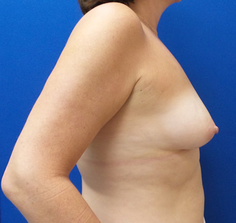 Direct to Implant Breast Reconstruction Before & After Gallery - Patient 154948922 - Image 5