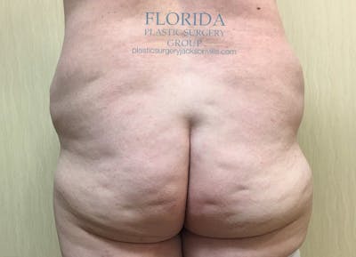Lower Body Lift Before & After Gallery - Patient 154948930 - Image 1