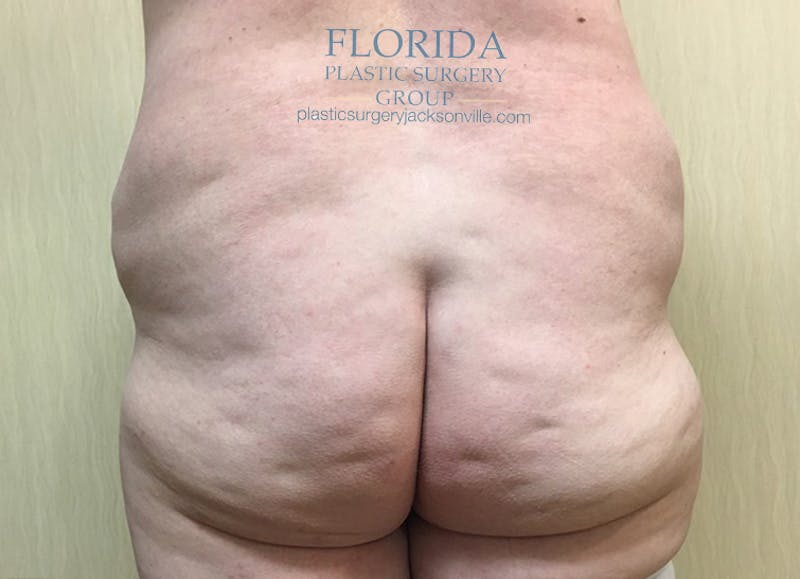 Lower Body Lift Before & After Gallery - Patient 154948930 - Image 1