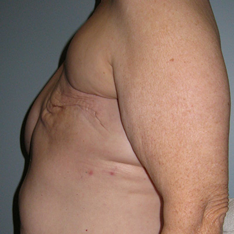 Latissimus Flap Reconstruction Before & After Gallery - Patient 154948919 - Image 3