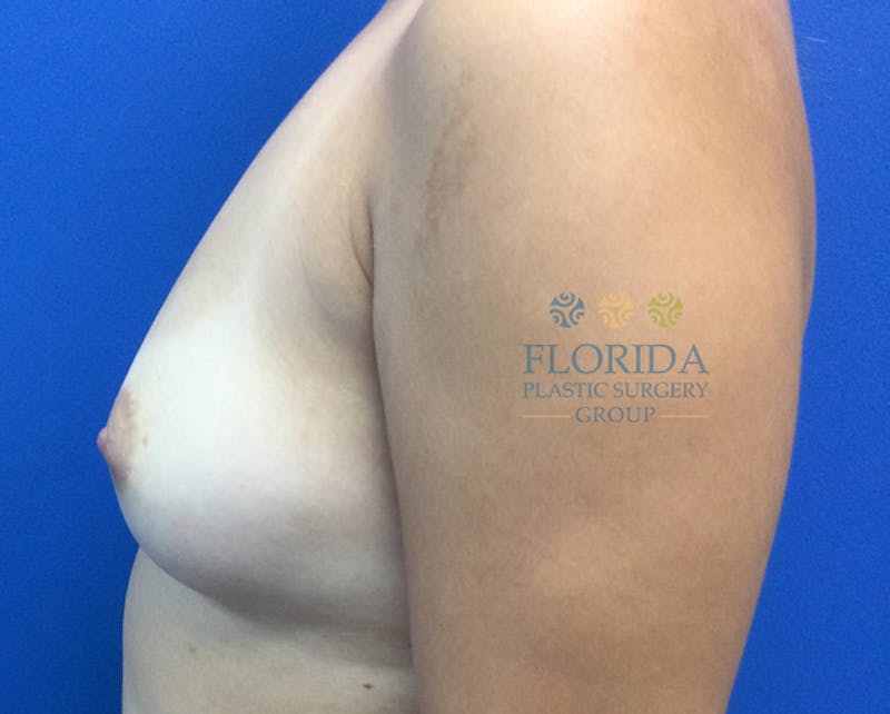 Saline Breast Augmentation Before & After Gallery - Patient 154948928 - Image 3