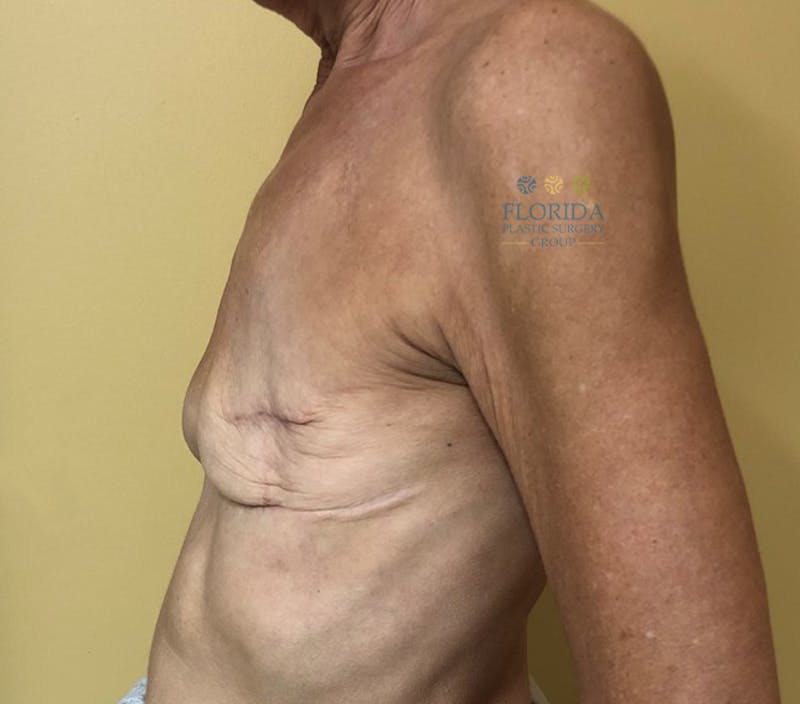 Breast Reconstruction Revision Before & After Gallery - Patient 154948934 - Image 5