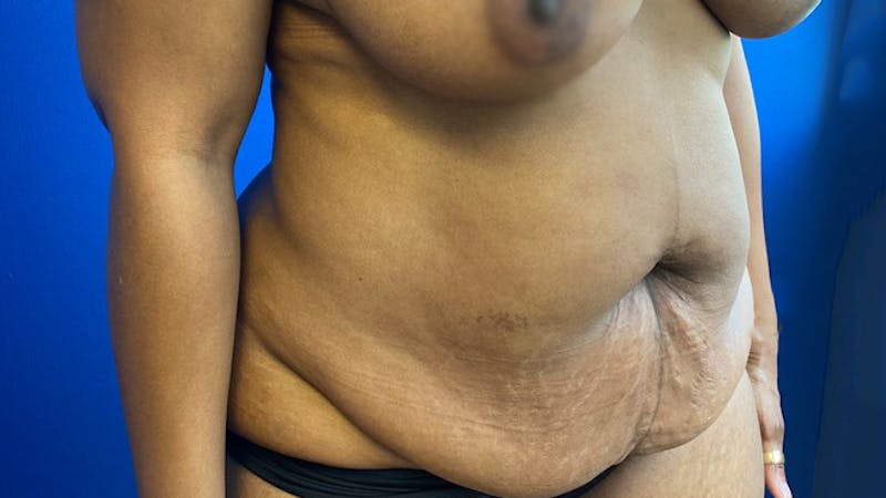 Abdominoplasty Before & After Gallery - Patient 154948929 - Image 3