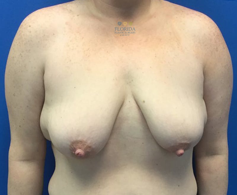 Augmentation Mastopexy Before & After Gallery - Patient 154948926 - Image 1