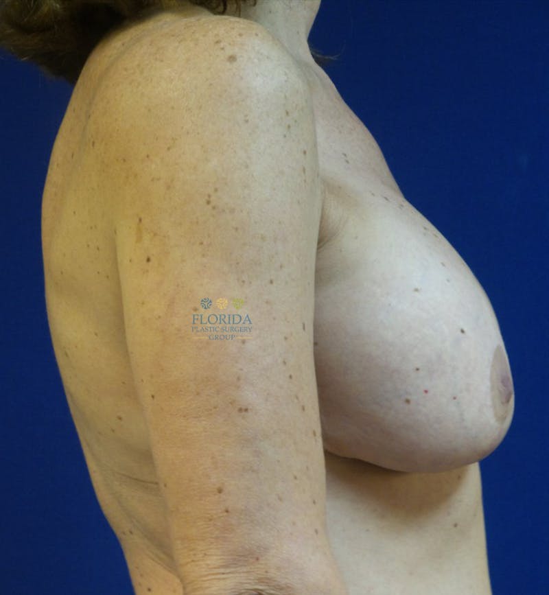 Breast Implant Removal Before & After Gallery - Patient 154948920 - Image 5