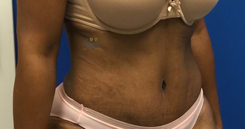 Abdominoplasty Before & After Gallery - Patient 154948929 - Image 4