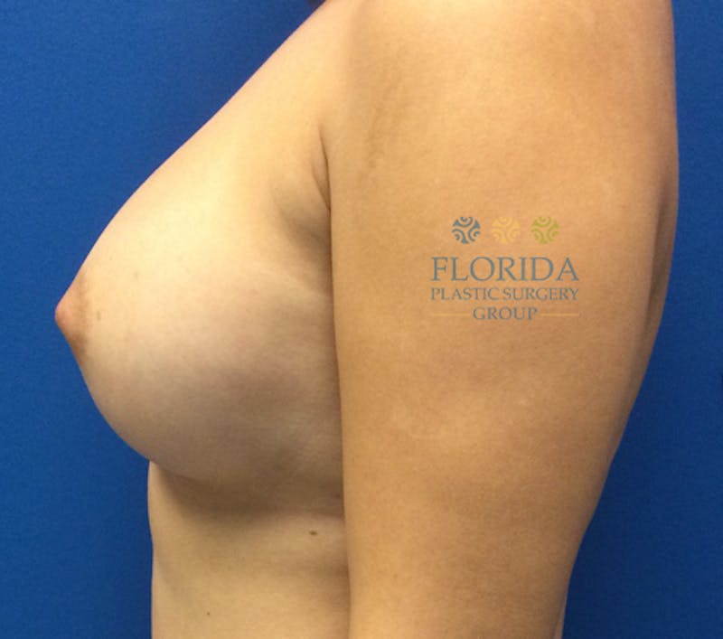 Saline Breast Augmentation Before & After Gallery - Patient 154948928 - Image 4