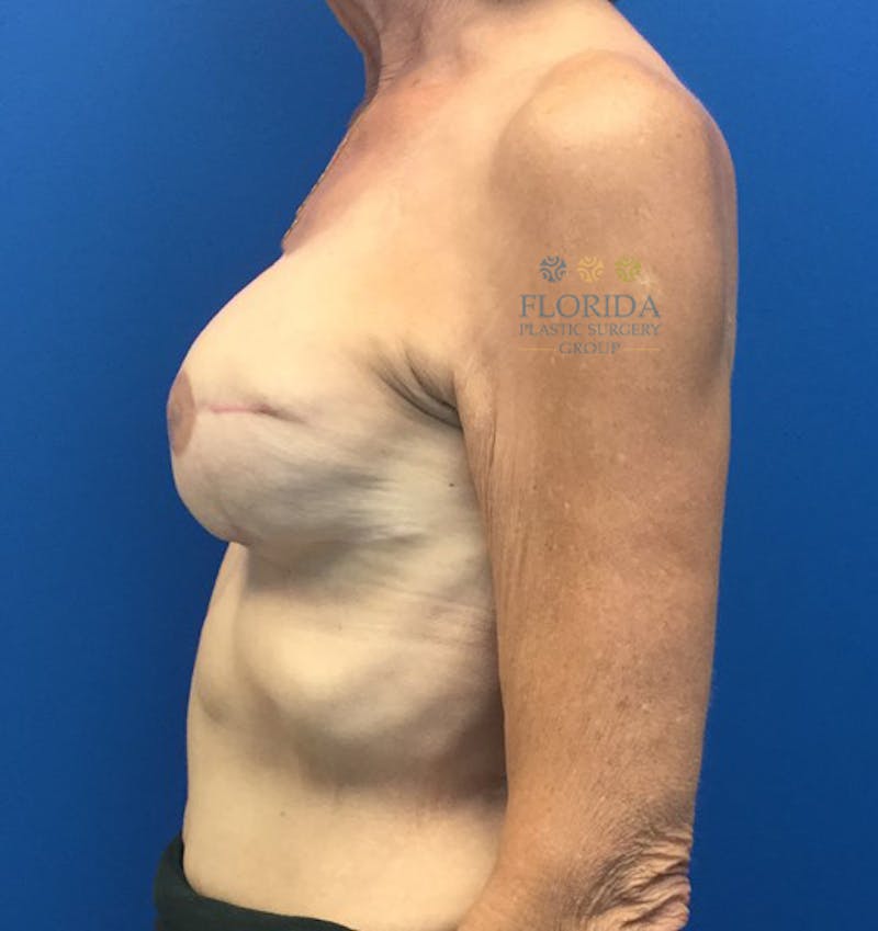 Breast Reconstruction Revision Before & After Gallery - Patient 154948934 - Image 6