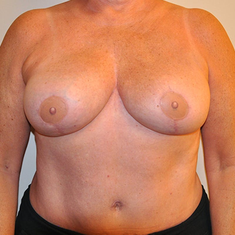 DIEP Flap Reconstruction Before & After Gallery - Patient 154948931 - Image 2