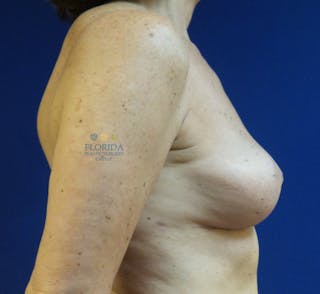 Breast Implant Removal Before & After Gallery - Patient 154948920 - Image 6