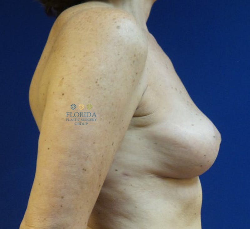 Breast Implant Removal Before & After Gallery - Patient 154948920 - Image 6