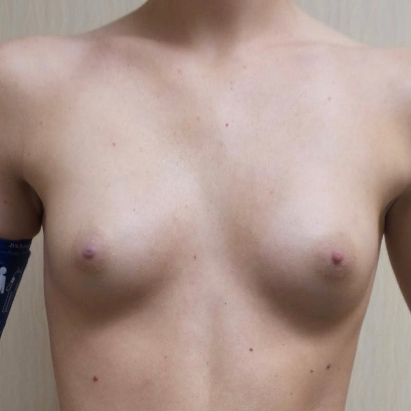 Silicone Breast Augmentation Before & After Gallery - Patient 154948943 - Image 1