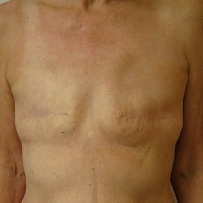 Latissimus Flap Reconstruction Before & After Gallery - Patient 154948933 - Image 1