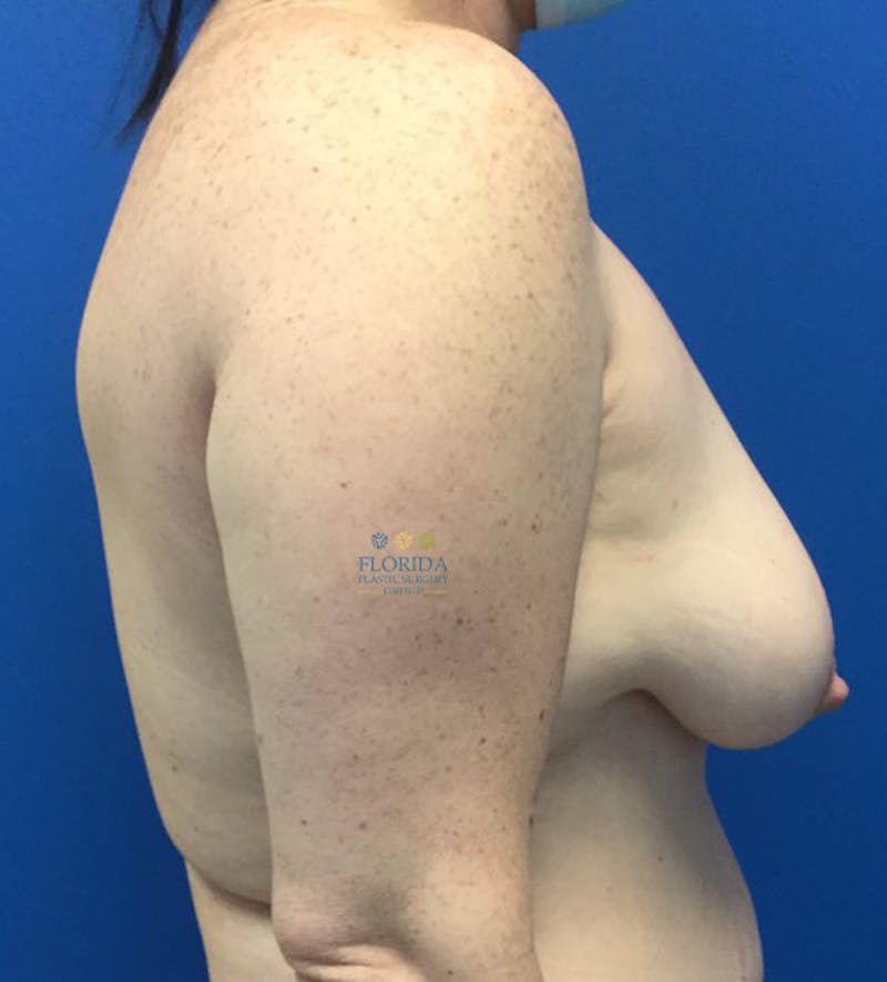 Augmentation Mastopexy Before & After Gallery - Patient 154948926 - Image 3