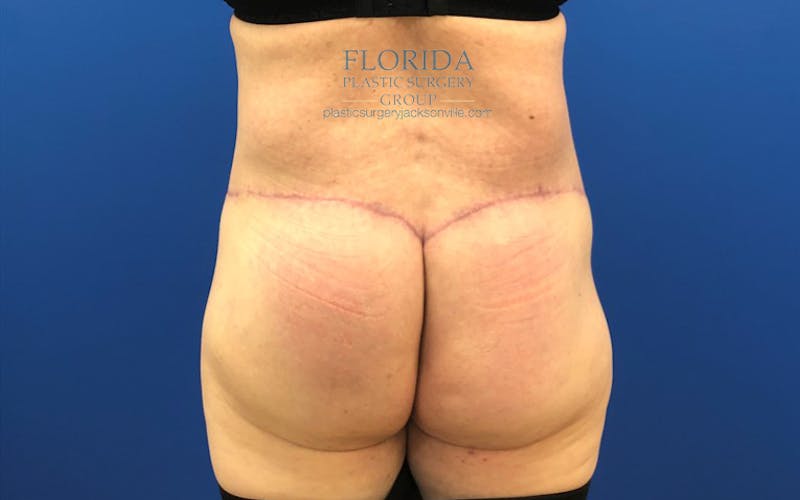 Lower Body Lift Before & After Gallery - Patient 154948930 - Image 2