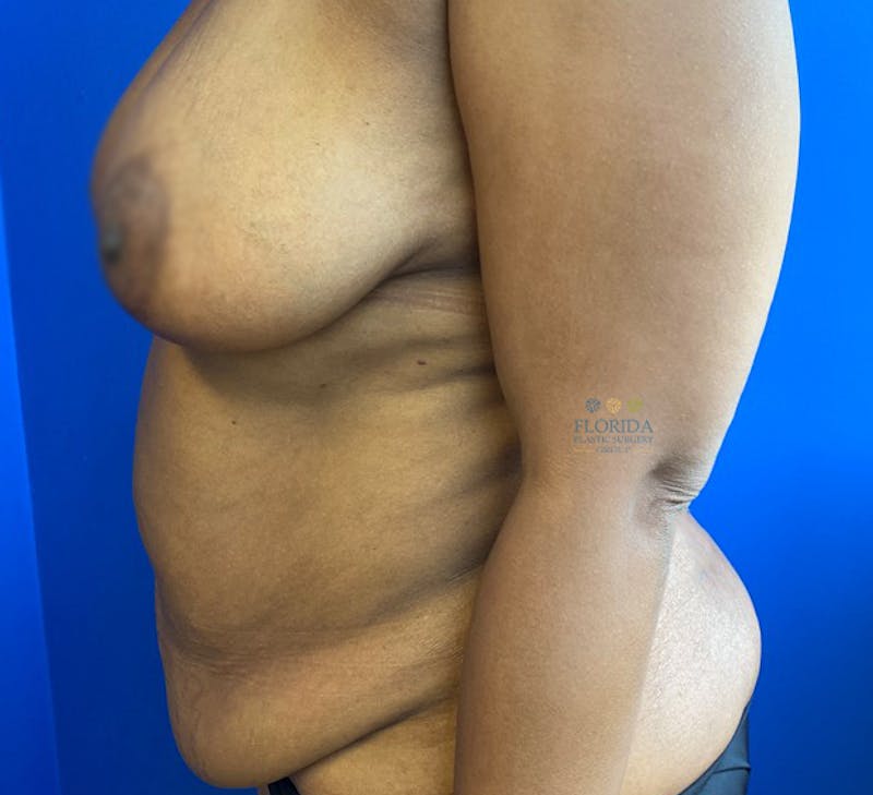 Abdominoplasty Before & After Gallery - Patient 154948929 - Image 5