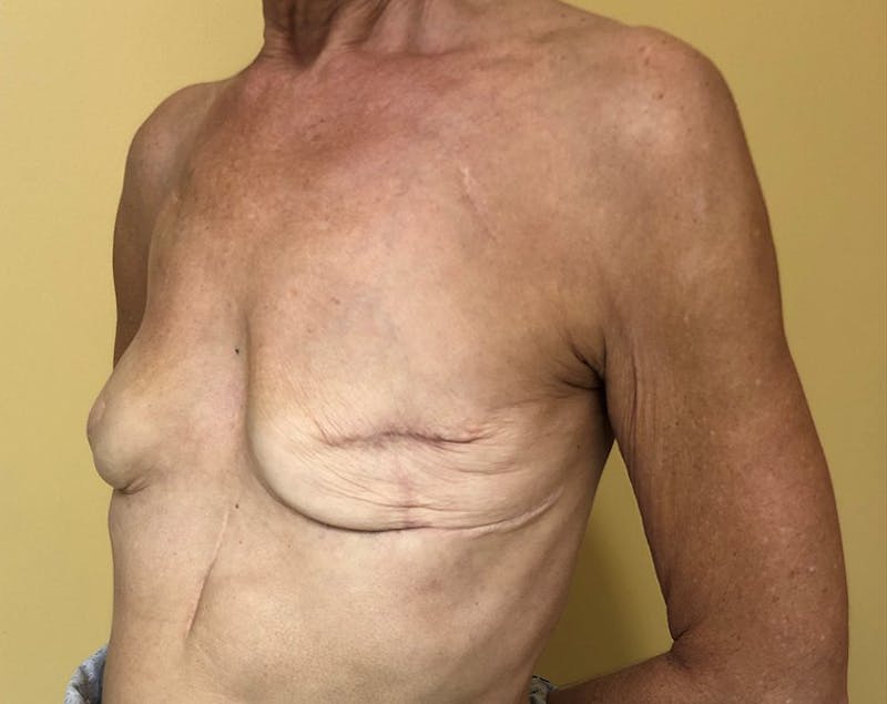 Breast Reconstruction Revision Before & After Gallery - Patient 154948934 - Image 7