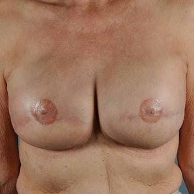 Latissimus Flap Reconstruction Before & After Gallery - Patient 154948933 - Image 2