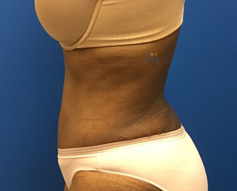 Abdominoplasty Before & After Gallery - Patient 154948929 - Image 6